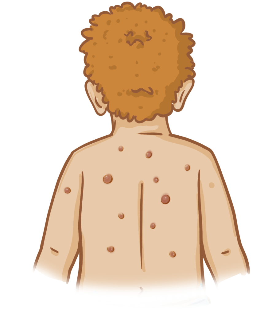 A child with neurofibroma on their back.