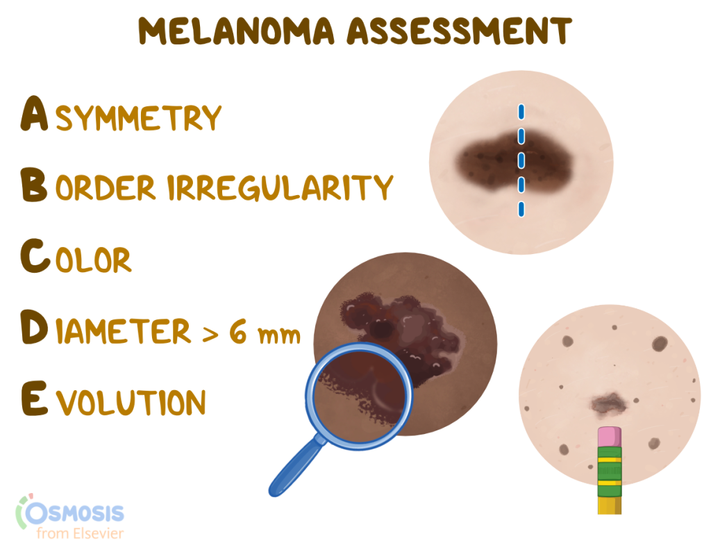 Asymmetry
Border Irregularity
Color
Diameter
Evolution